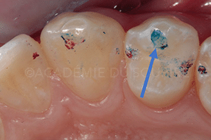 Marquage occlusion dentaire