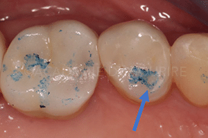 Marquage occlusion dentaire