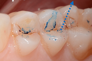Marquage occlusion dentaire