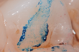 Marquage occlusion dentaire