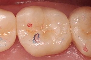 Marquage occlusion dentaire
