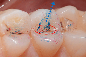 Marquage occlusion dentaire