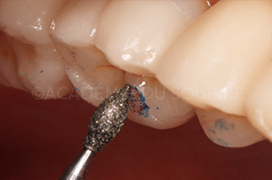 Marquage occlusion dentaire