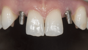 atténuer gris faux moignon provisoire