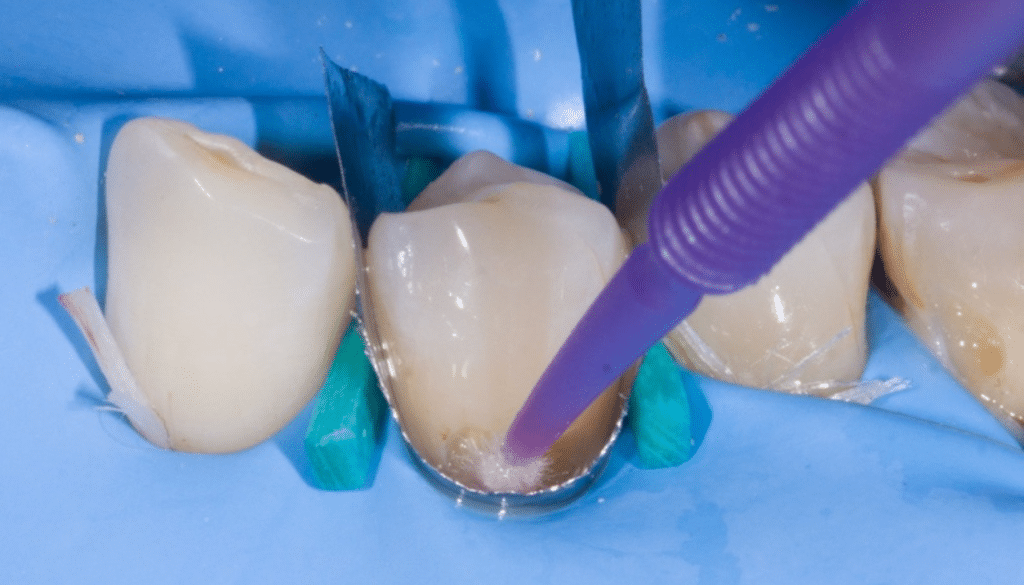 Caries cervicales