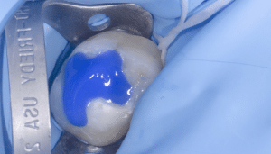 Collage biodentine