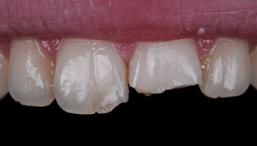composites stratifiés dent