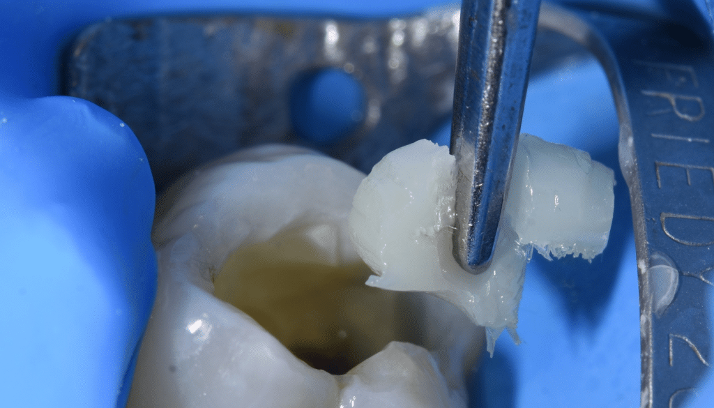 Composites fibrés dentaire