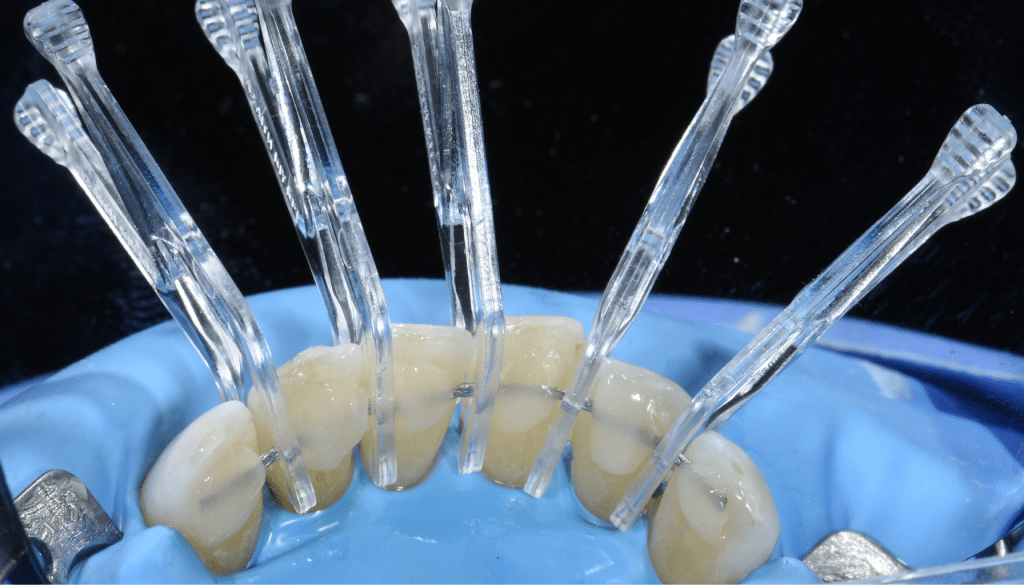 Contention orthodontique