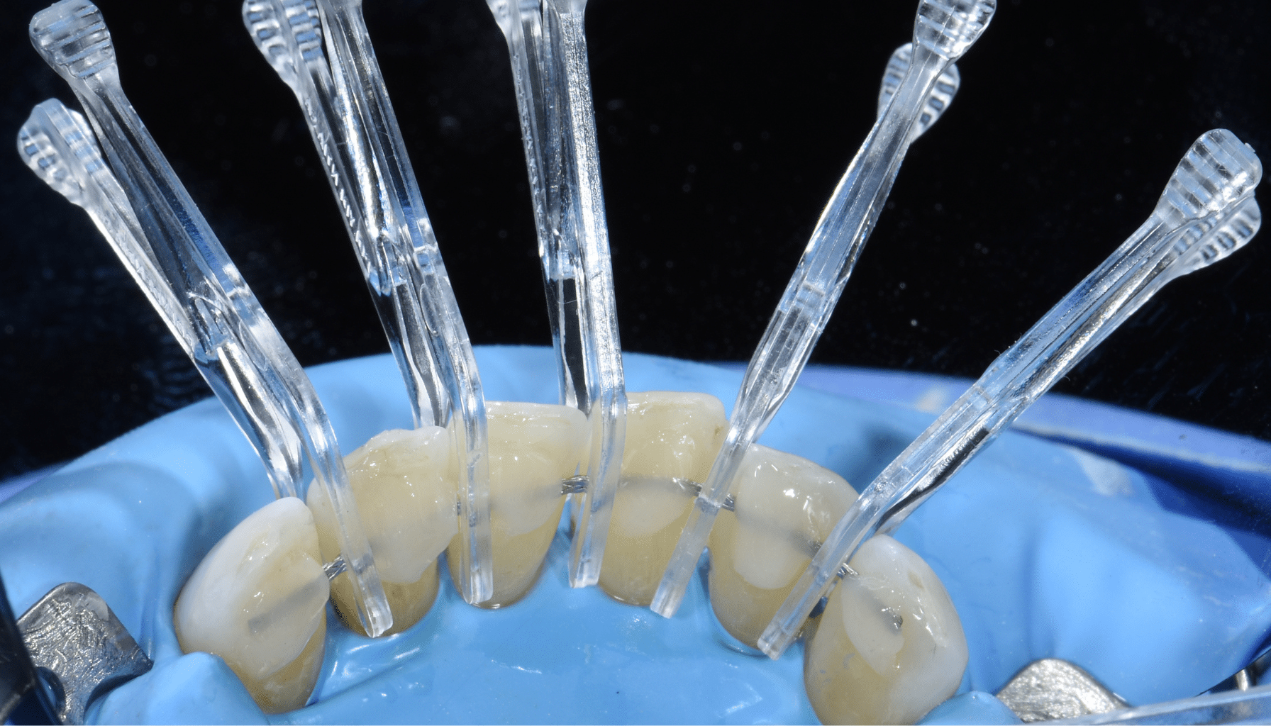 Contention orthodontique