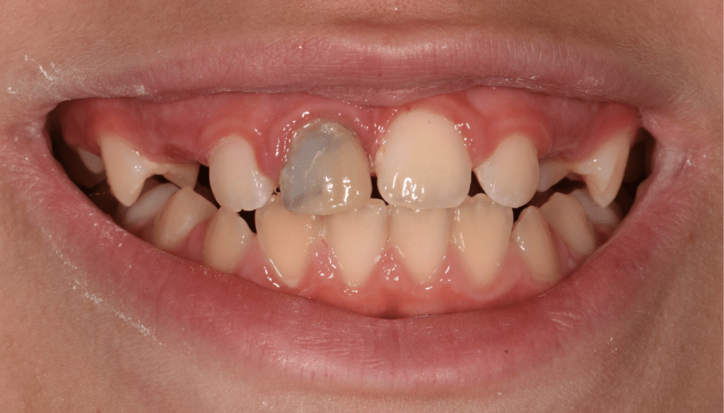 masquer discoloration dentaire résine composite
