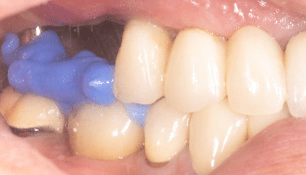 Enregistrement occlusal