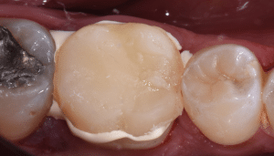 Eviter décollement provisoires dentaire
