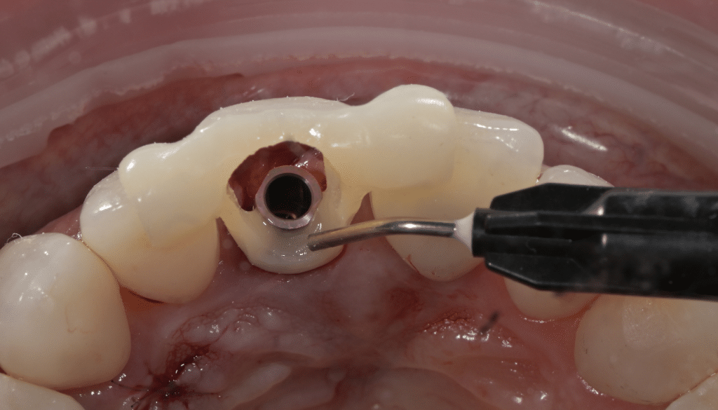 Extraction implant dentaire