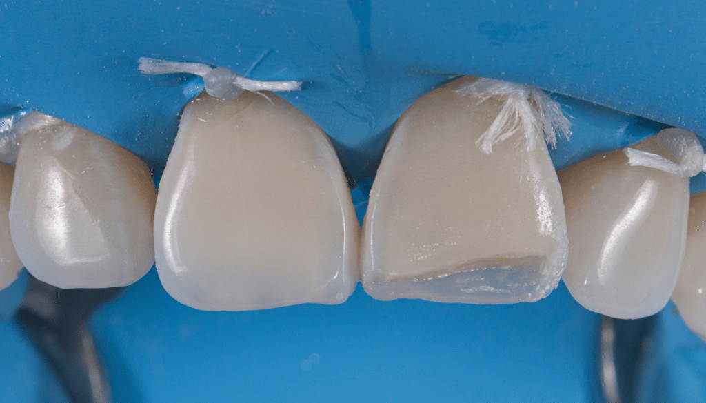 face proximale stratification
