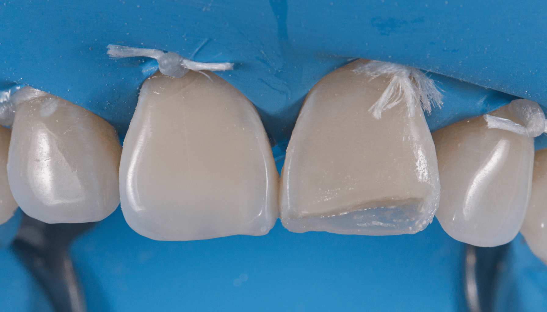 face proximale stratification