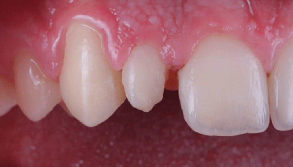 reproduire taches fluorose dent provisoire