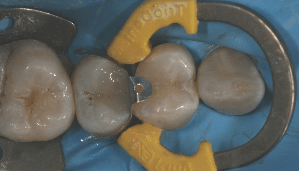 Gestion des effractions pulpaires