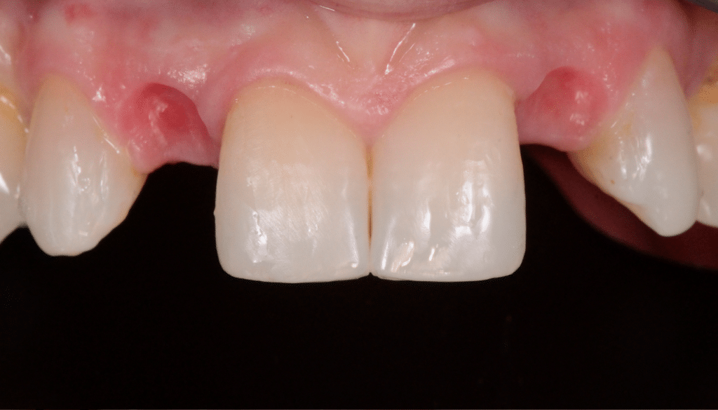 Gestion mucco gingivale intermediaire bridge