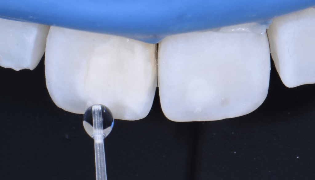diagnostic hypominéralisation de l'émail dentaire