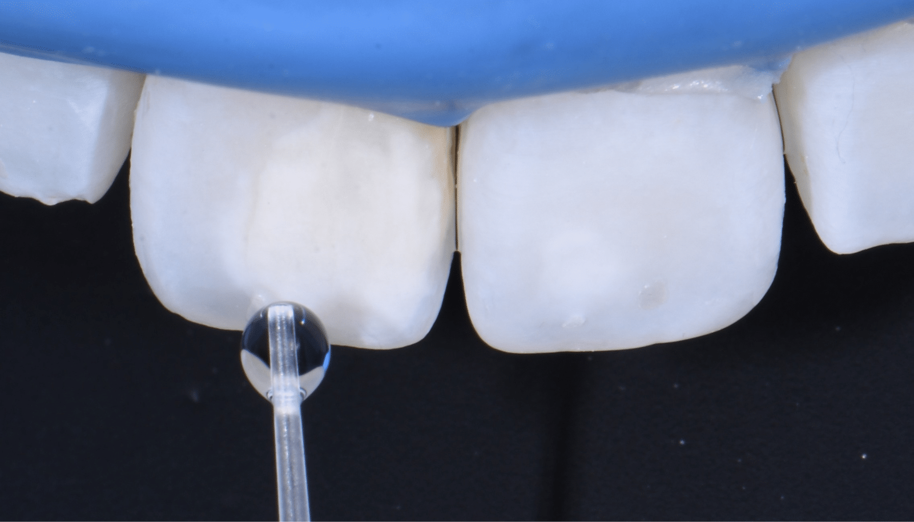 diagnostic hypominéralisation de l'émail dentaire