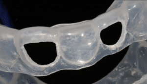 éclaircir dent dépulpée