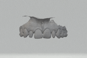composite injecté clé silicone