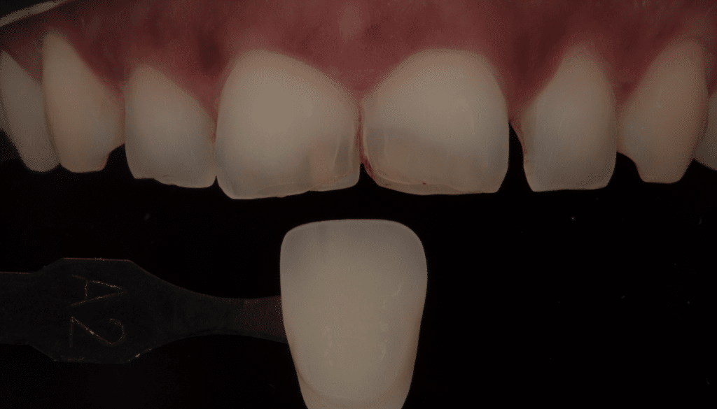 Photo polarisée en dentisterie
