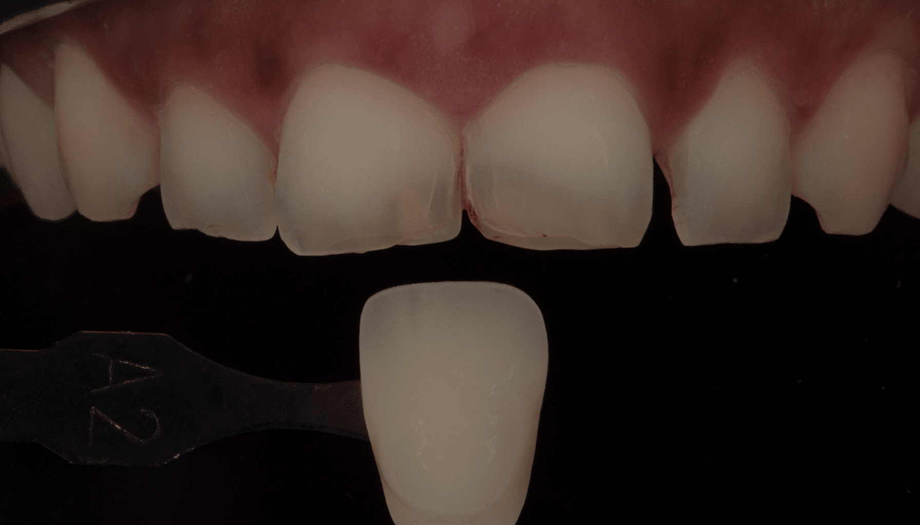 Photo polarisée en dentisterie