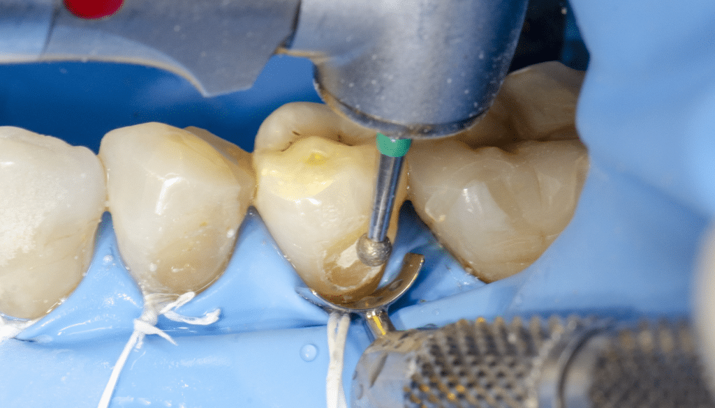 Préservation gingivale