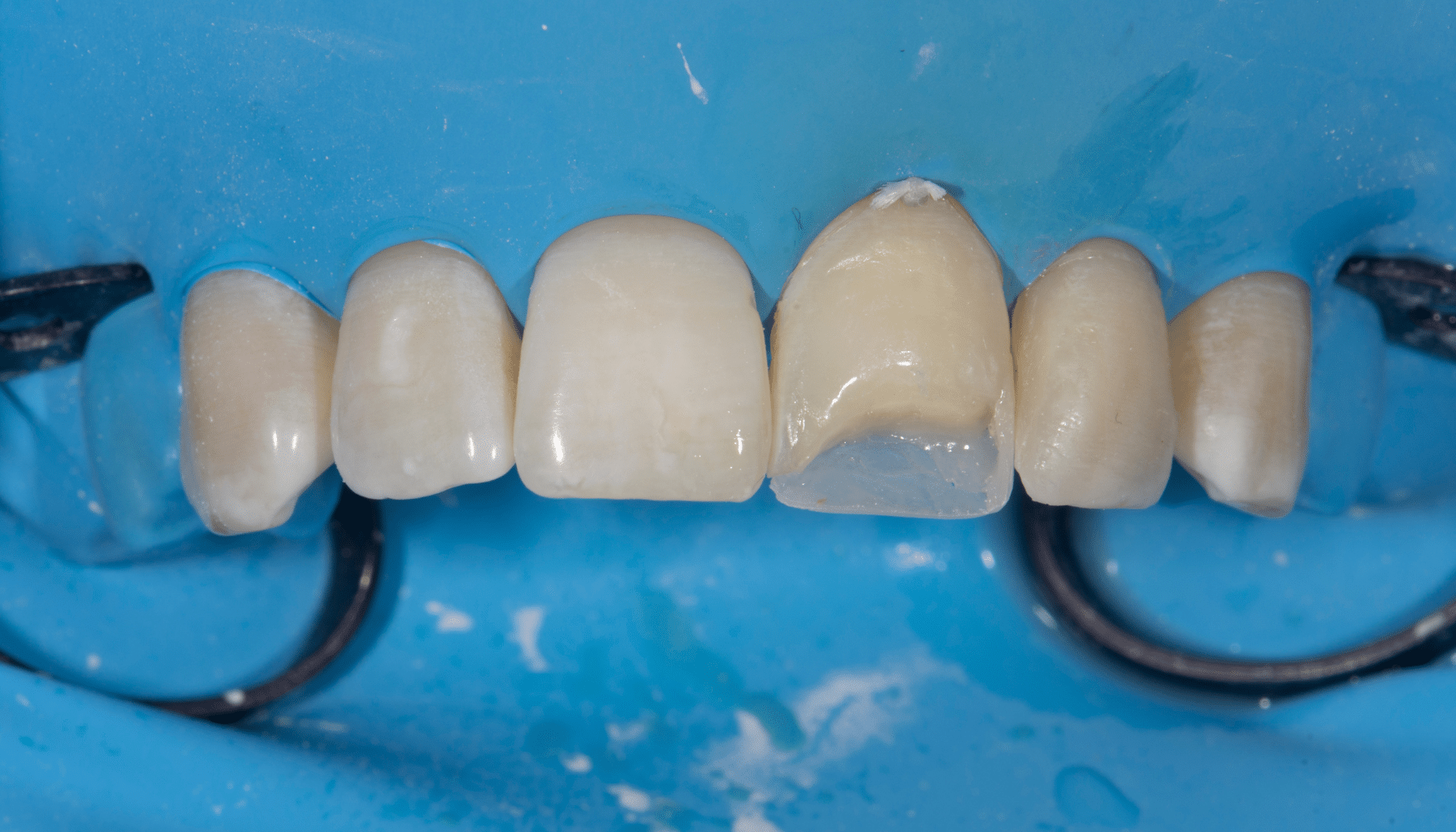 Restauration directe antérieure composite