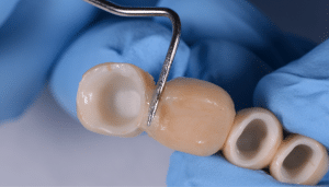 élimination ciment de scellement bridge dentaire