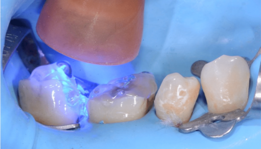 scellement dentinaire immédiat SDI