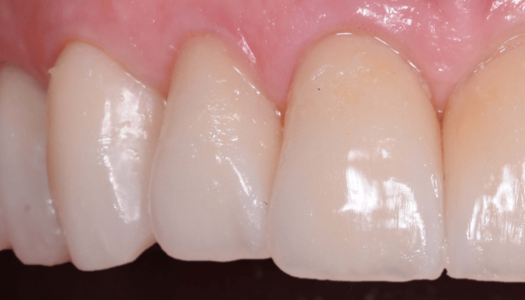 Scellement dent provisoire