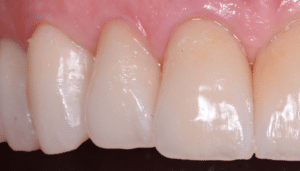 Scellement dent provisoire