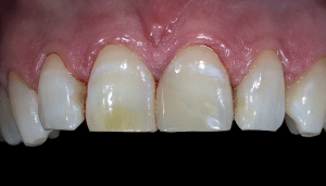 relevé de couleur dent smartphone