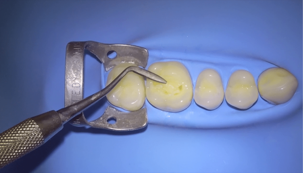 Stamp technique dent