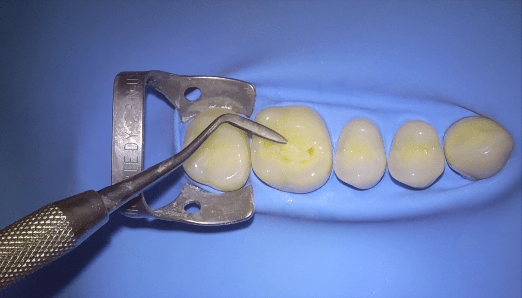 Stamp technique dent