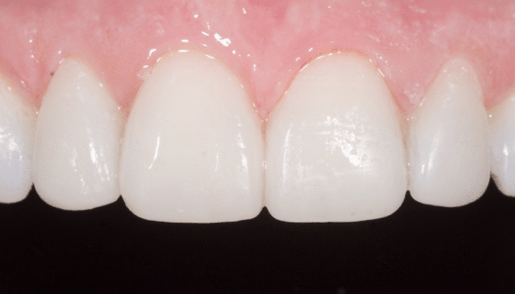 Temporisation facettes