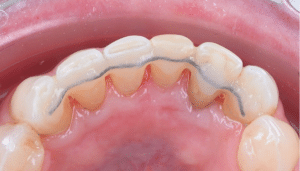 astuce dentaire contention