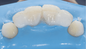 collage bridge cantilever emax