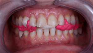 Conseil usures dentaires