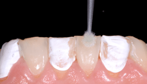 Astuce précision résines composites
