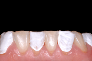 Astuce précision résine composite 3a