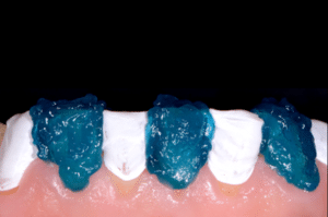 Astuce précision résine composite 3b