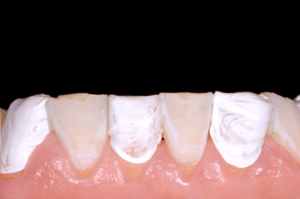 Astuce précision résine composite 4a