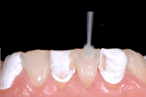 Astuce précision résine composite 4b