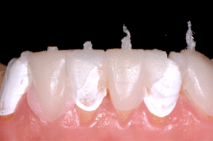 Astuce précision résine composite 6b