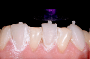 Astuce précision résine composite 7a