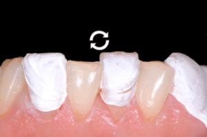 Astuce précision résine composite 7b